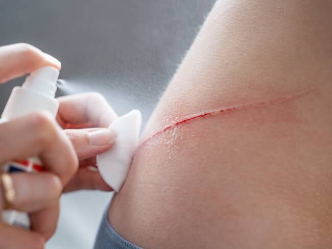 ¿Cómo limpiar herida superficiales? - Getty Images