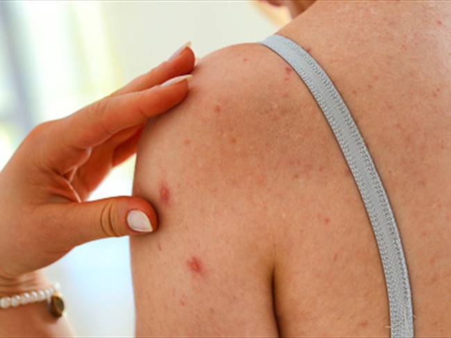 Alerta en Valle por posible brote de sarampión. Foto: Getty Images