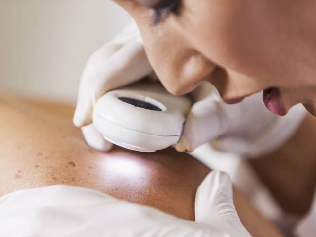 ¿Cómo prevenir el cáncer de piel? Una de las enfermedades más comunes