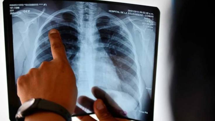 Casos de tuberculosis en UPPV de Pereira / Foto: AFP