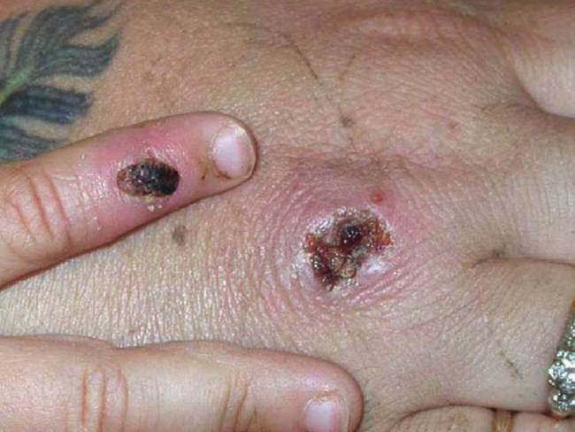 Lesiones en la piel tras contagio con viruela del mono.              Foto: Getty 