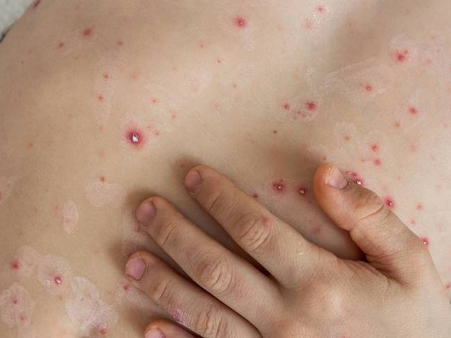 Expertos aclaran que la viruela no es una enfermedad de transmisión sexual. Foto: Getty Images.