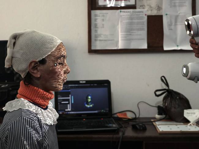 Máscaras impresas en 3D para curar rostros quemados en Gaza