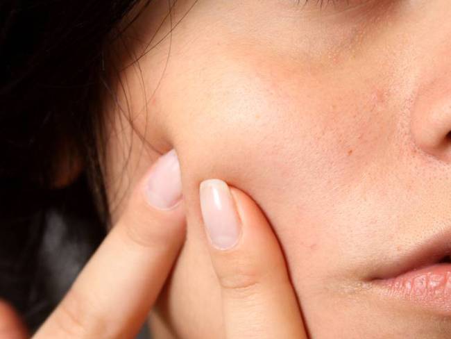 El carrusel que viven los jóvenes con acné en busca de tratamiento