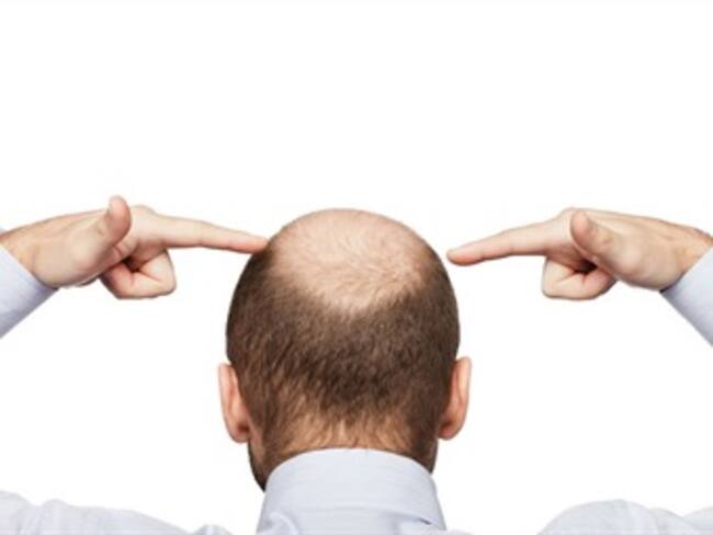 Clonación de pelo le pone fin a la calvicie