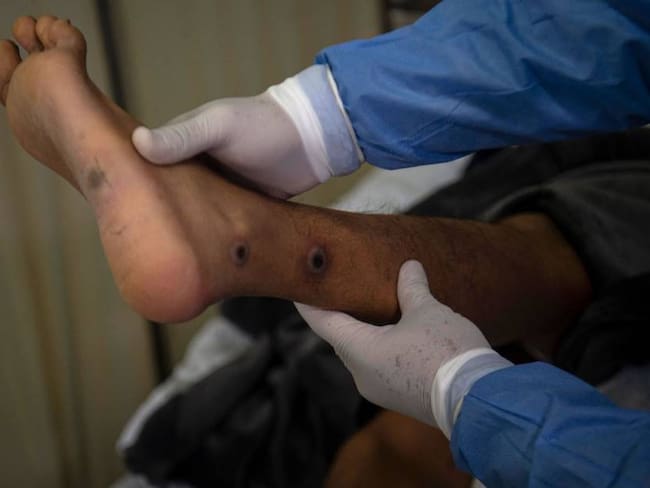 Heridas en la piel tras contagio con la viruela del mono.          Foto: Getty 