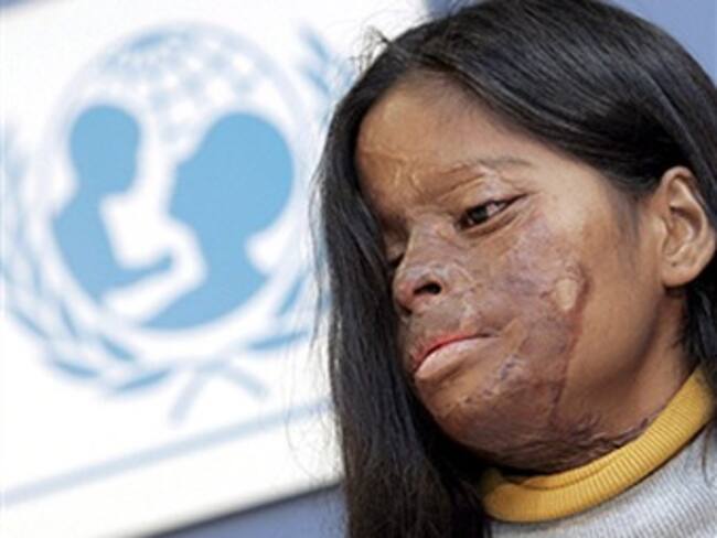 Bangladesh, Pakistán e India son los países con más ataques con ácido