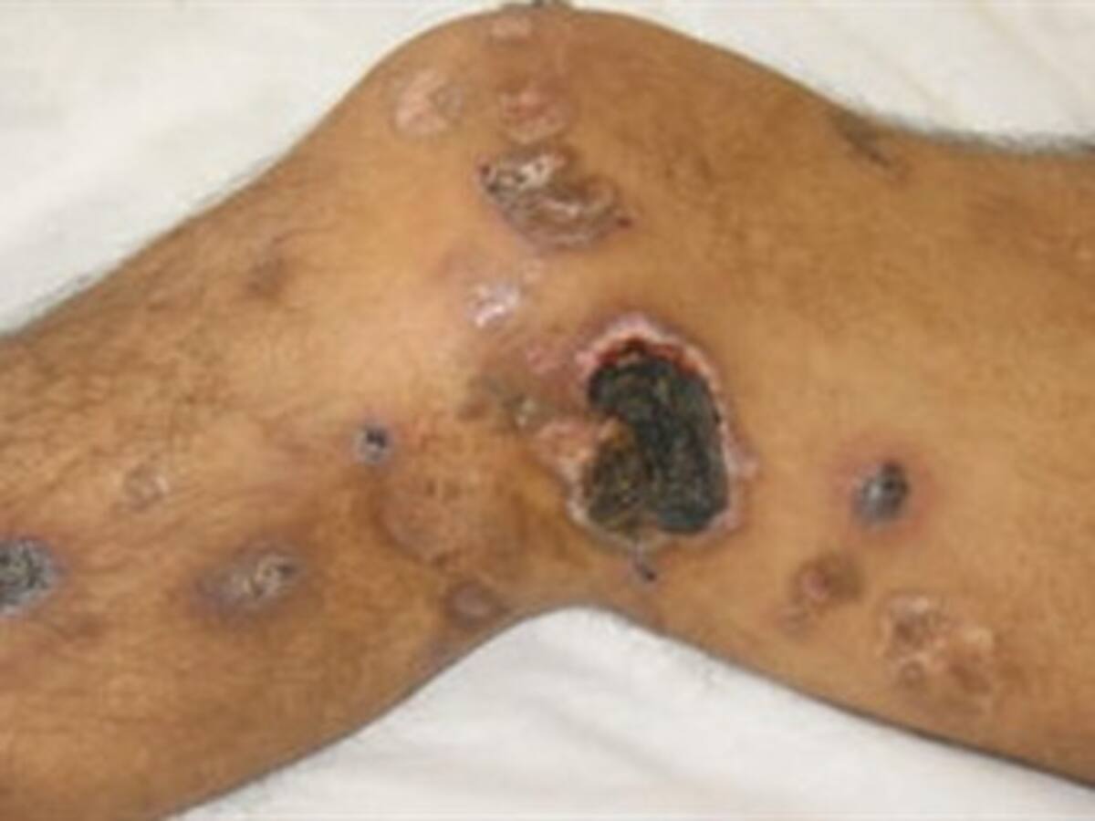 El Linfoma, un cáncer silencioso y común