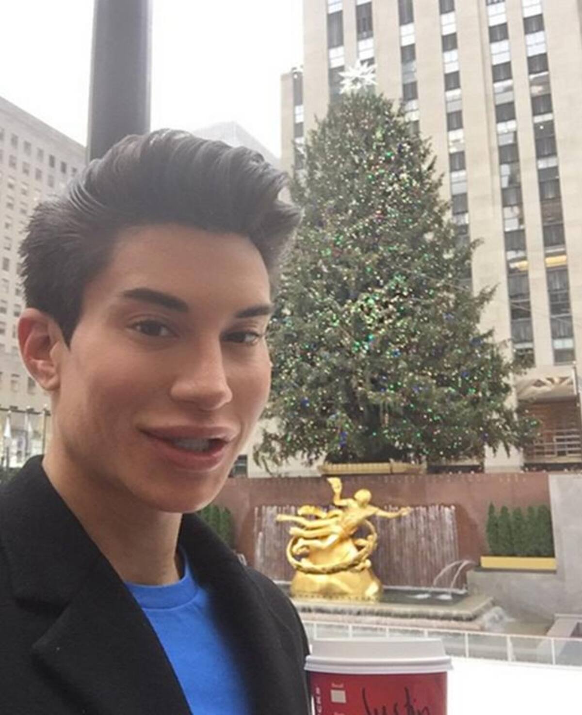 Justin Jedlica se operó para remover tres venas de su frente, intervención que lo pudo dejar ciego. Fotos: Instagram.