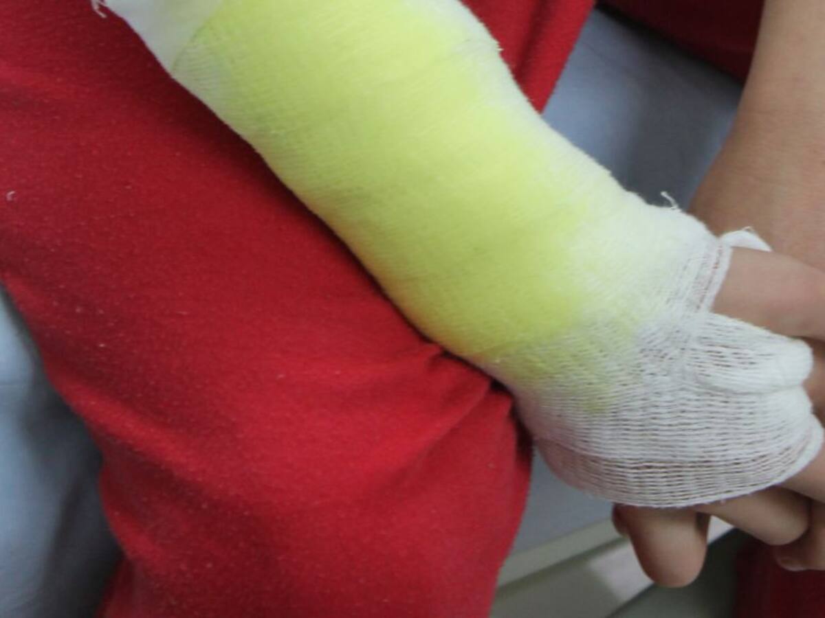 Dos niños de 9 y 10 años quemados con pólvora en Medellín
