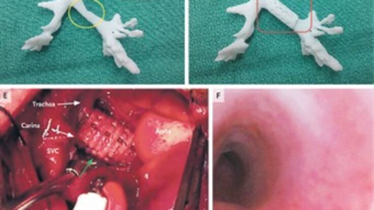 Salvan la vida de un bebé con prótesis creada en impresora 3D