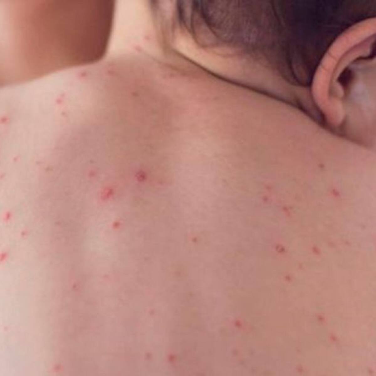 Sarampión: OPS lanza alerta epidemiológica en América por persistencia de casos
