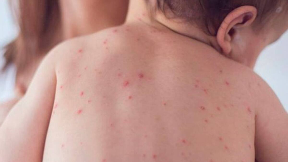 Sarampión: OPS lanza alerta epidemiológica en América por persistencia de casos