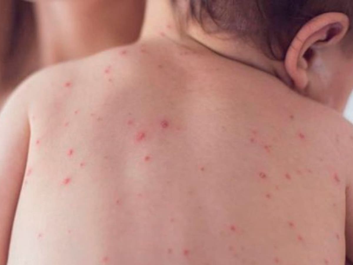 Sarampión: OPS lanza alerta epidemiológica en América por persistencia de casos