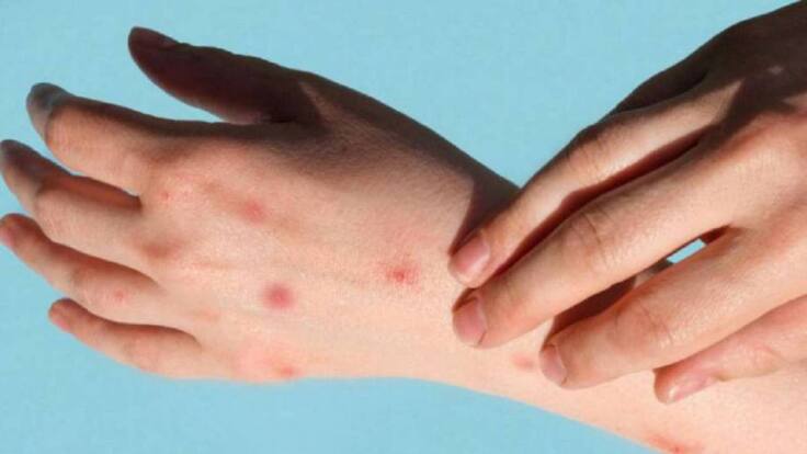 EINA DE LA HOZ, DIRA SALUD PÚBLICA SANTA MARTA - VIRUELA DEL MONO