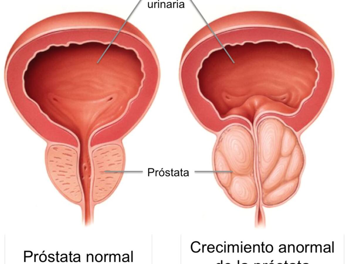 El silencio no es una opción: la urgencia de hablar y actuar contra el cáncer de próstata