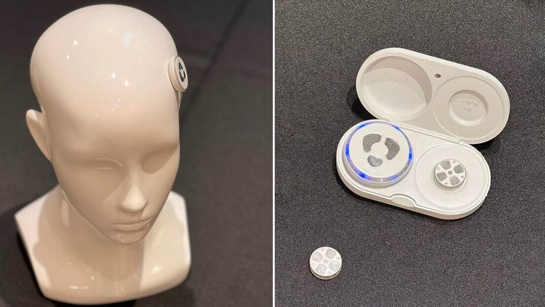 Implante que promete curar la depresión / Twitter: @Sepa_mass