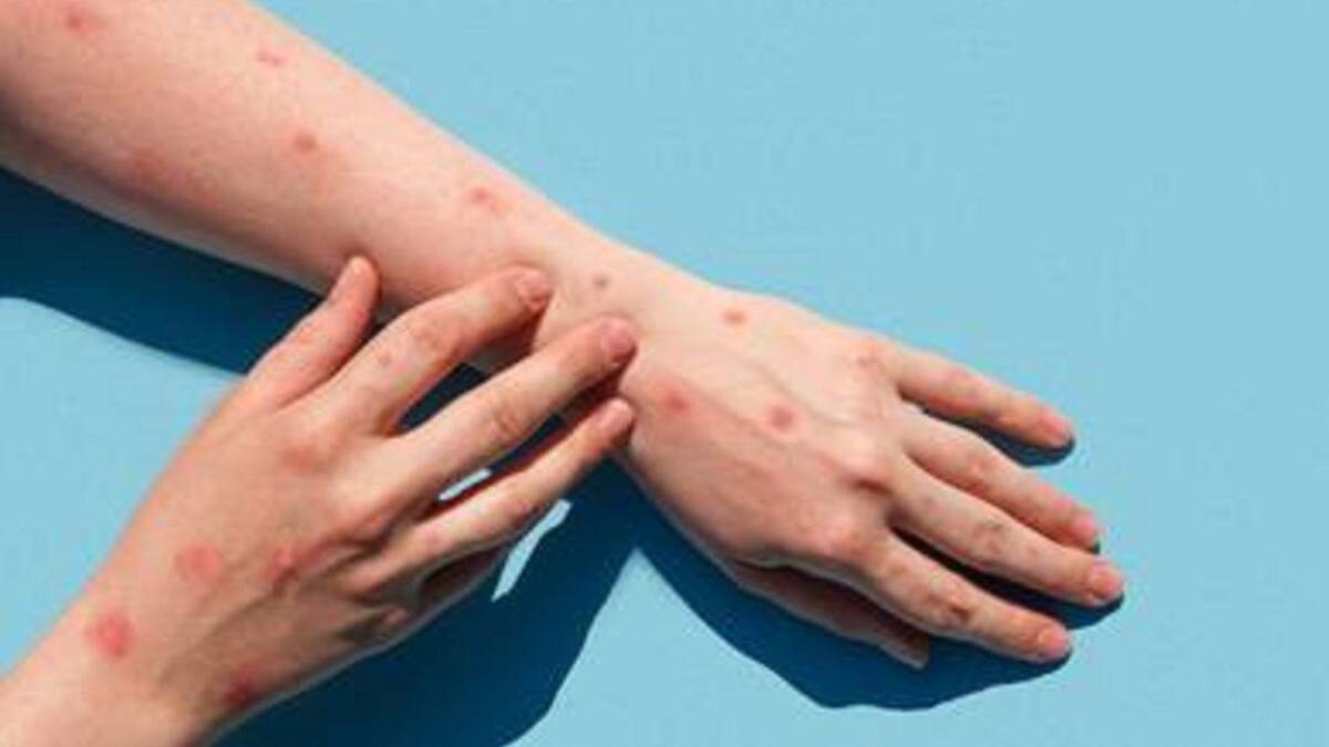 Posible caso sospechoso de viruela del mono en Bucaramanga