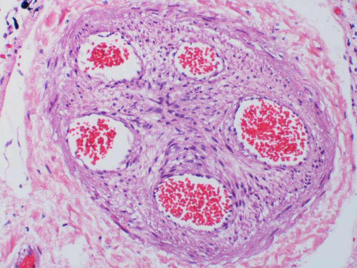 Trombosis, afección responsable de 1 de cada 4 muertes en el mundo