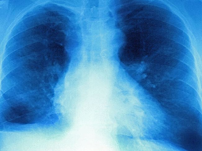 Pacientes Covid-19 podrían perder hasta el 80% de la capacidad pulmonar