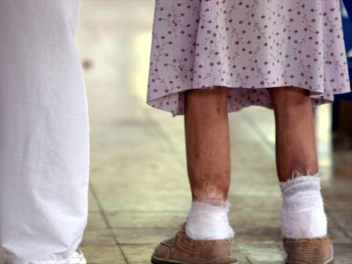 En el 2015 todos los municipios del país deben reducir casos de lepra