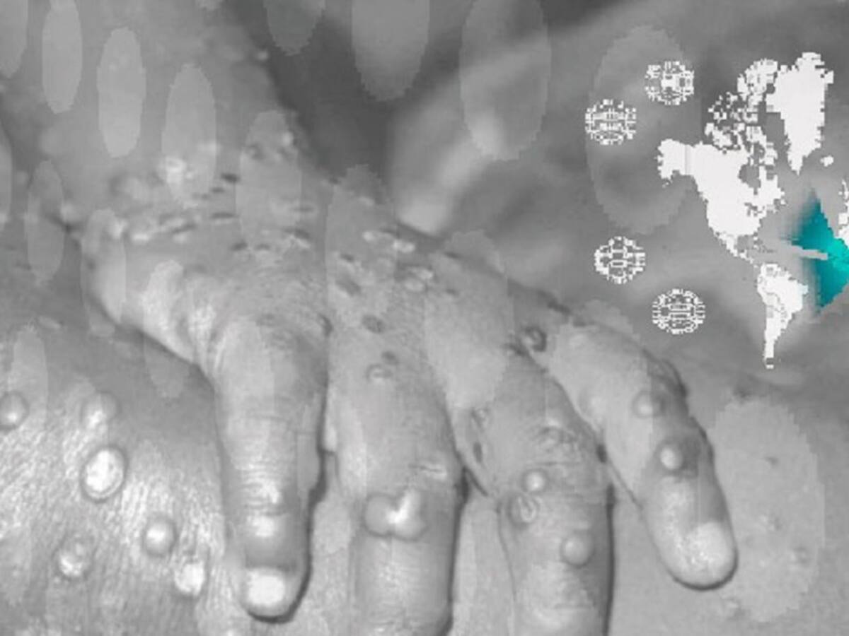 Confirman primer caso de Viruela Símica en el Valle del Cauca