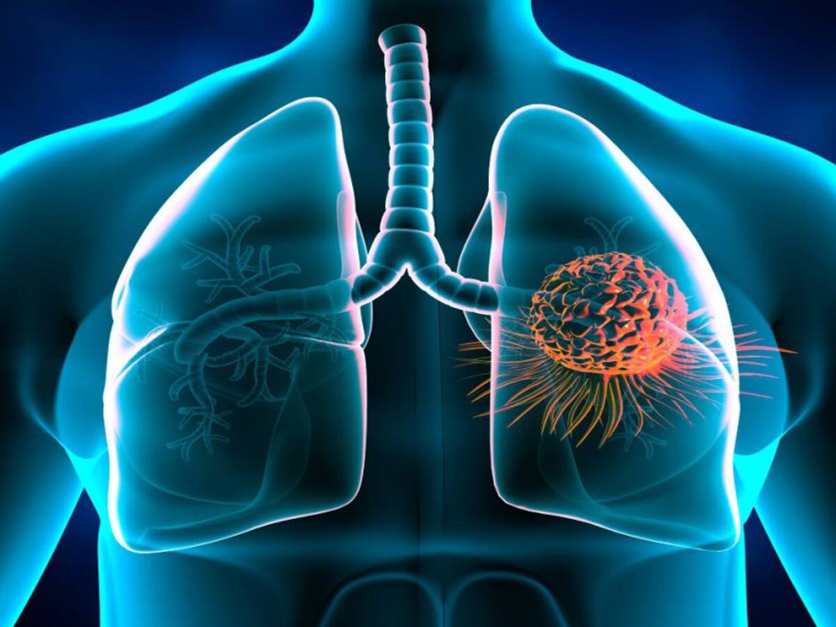 Cáncer de pulmón, más allá del tabaquismo