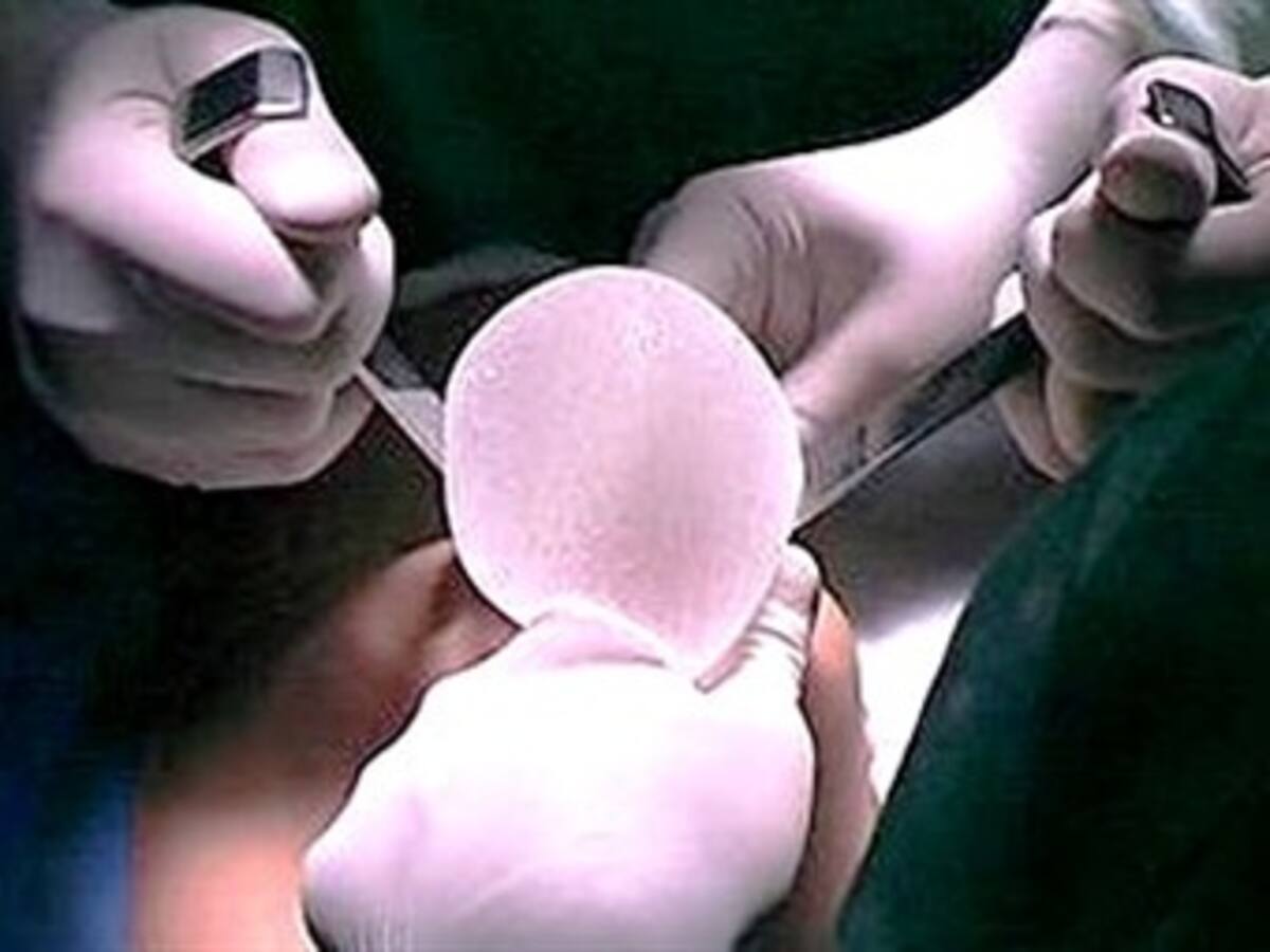 Por mala cirugía estética, mujer pierde sus senos