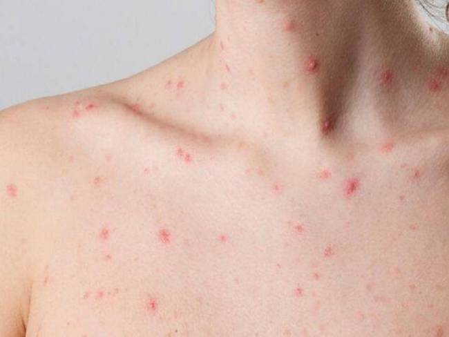 Persona con Viruela del mono (MPOX) //  Oficial Colprensa (Archivo)