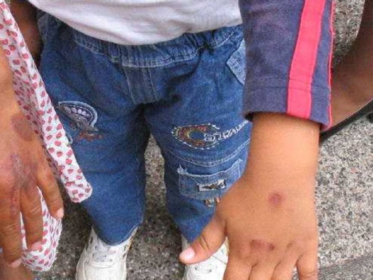 A una niña le quemaron sus manos como castigo, en el oriente de Cali