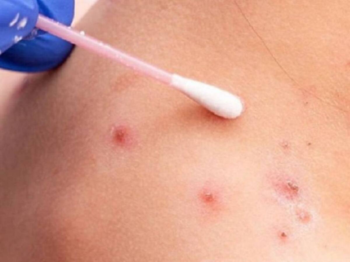 Reportan cinco nuevos casos de viruela del mono en el Atlántico