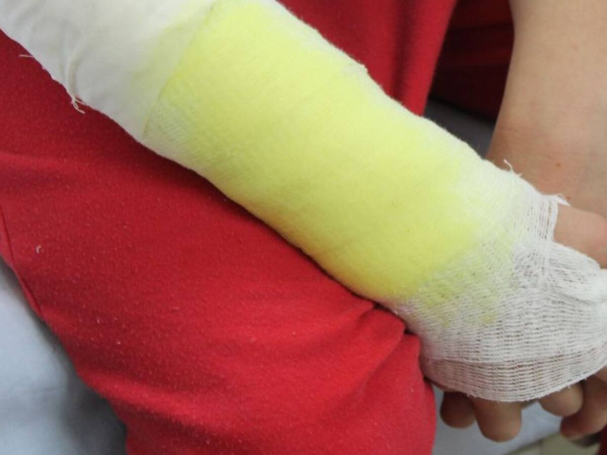 Cuatro nuevos quemados con pólvora