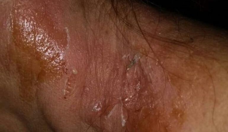 Efectos de la sustancia que expulsa el insecto.