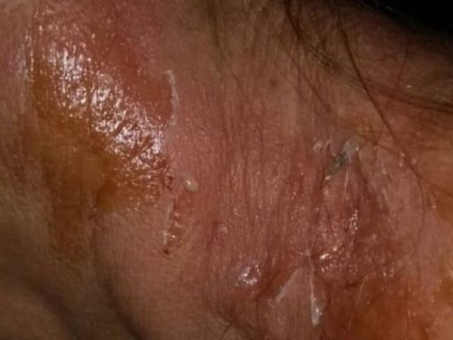 Efectos de la sustancia que expulsa el insecto.