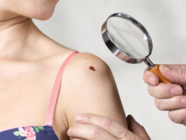 “Al año, Colombia podría registrar más de 26.000 casos de cáncer de piel”