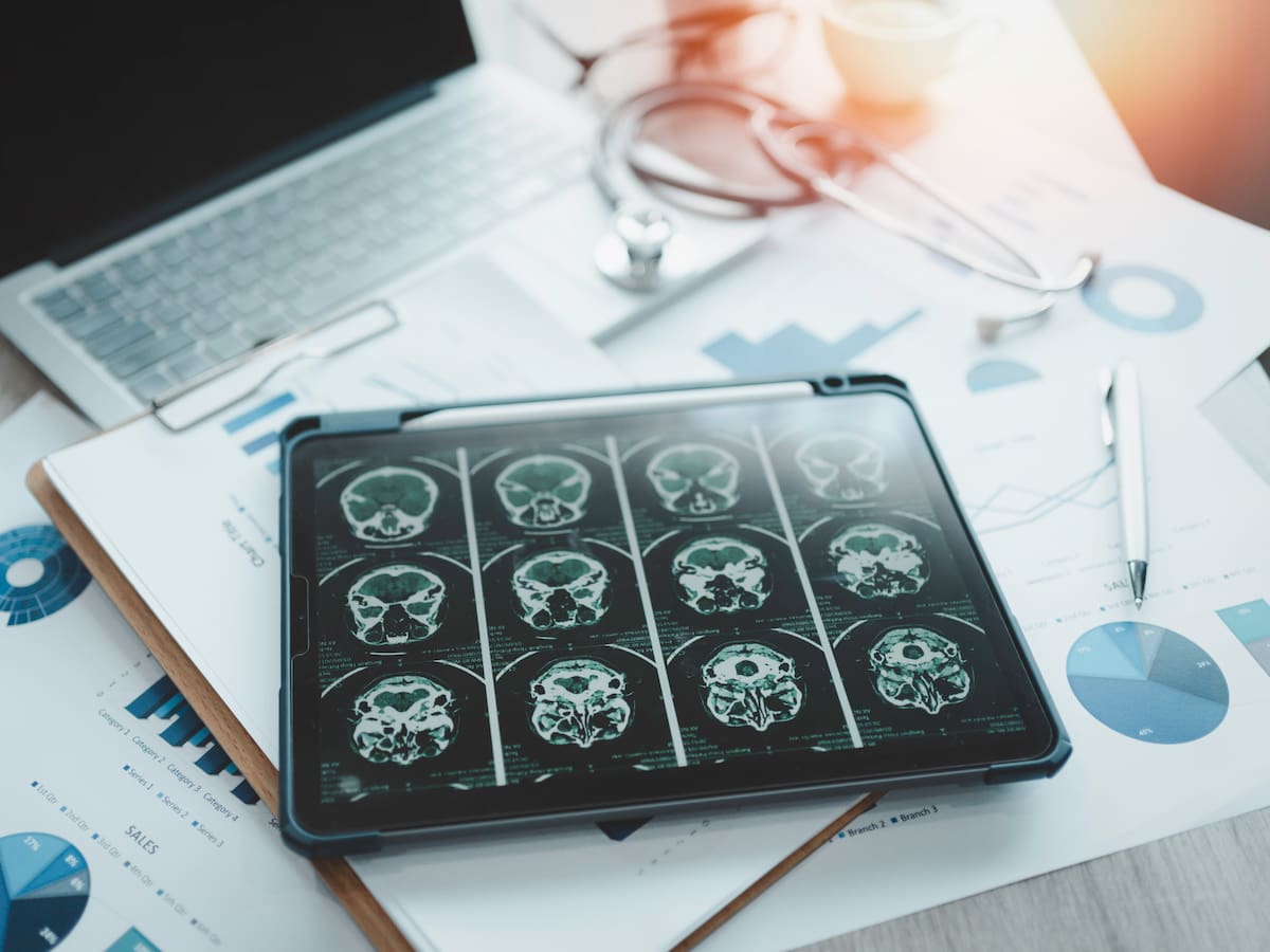 La proteína beta amiloide estaría relacionada con las causas del alzhéimer, según experto