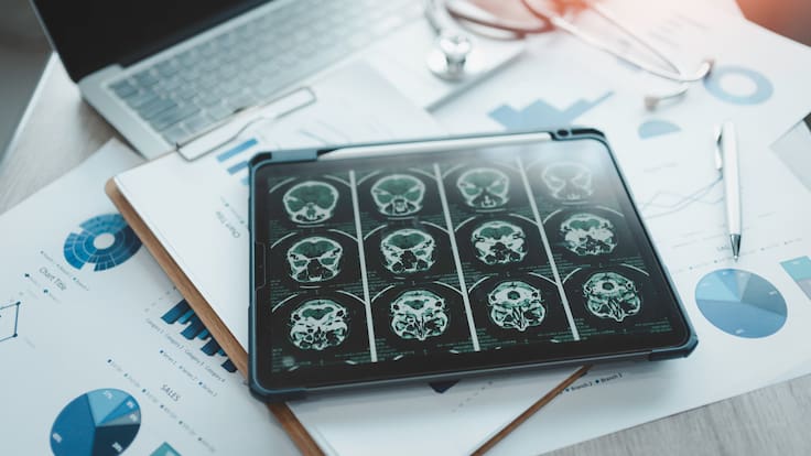 La proteína beta-amiloide estaría relacionada con las causas del alzhéimer, según experto