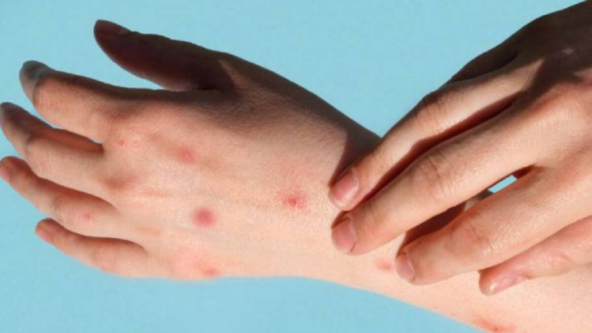 Confirman el primer caso de viruela del mono en Boyacá