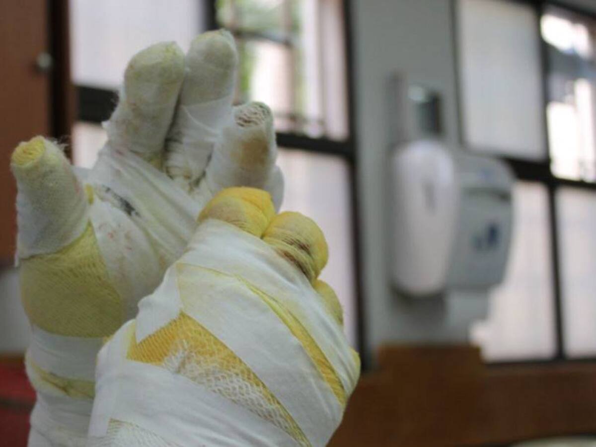 Antioquia alcanzó los 100 casos de quemados con pólvora