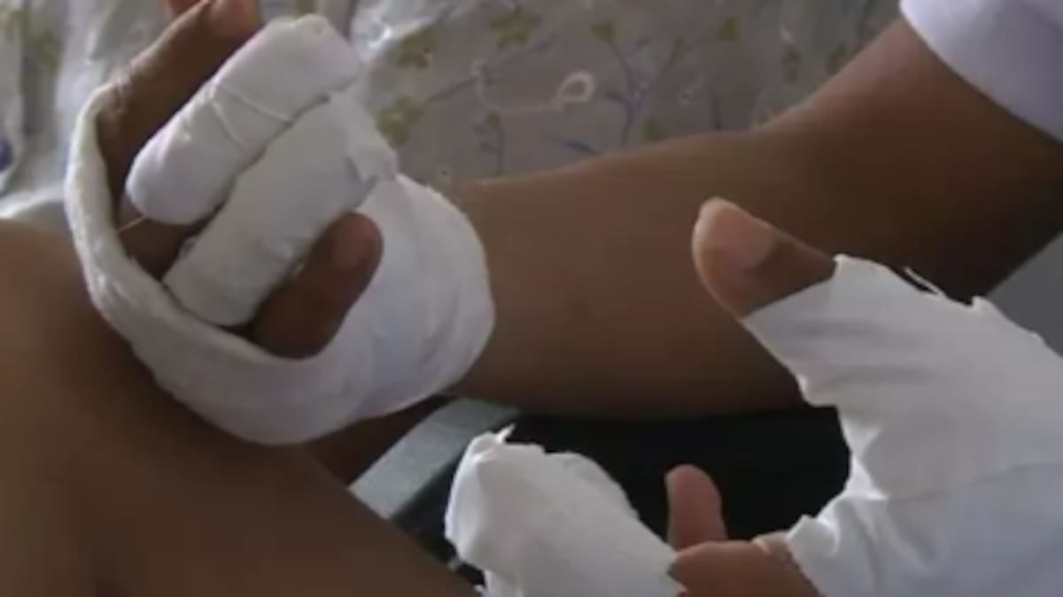 La celebración de fin de año en Antioquia deja 35 quemados con pólvora, nueve son menores de edad