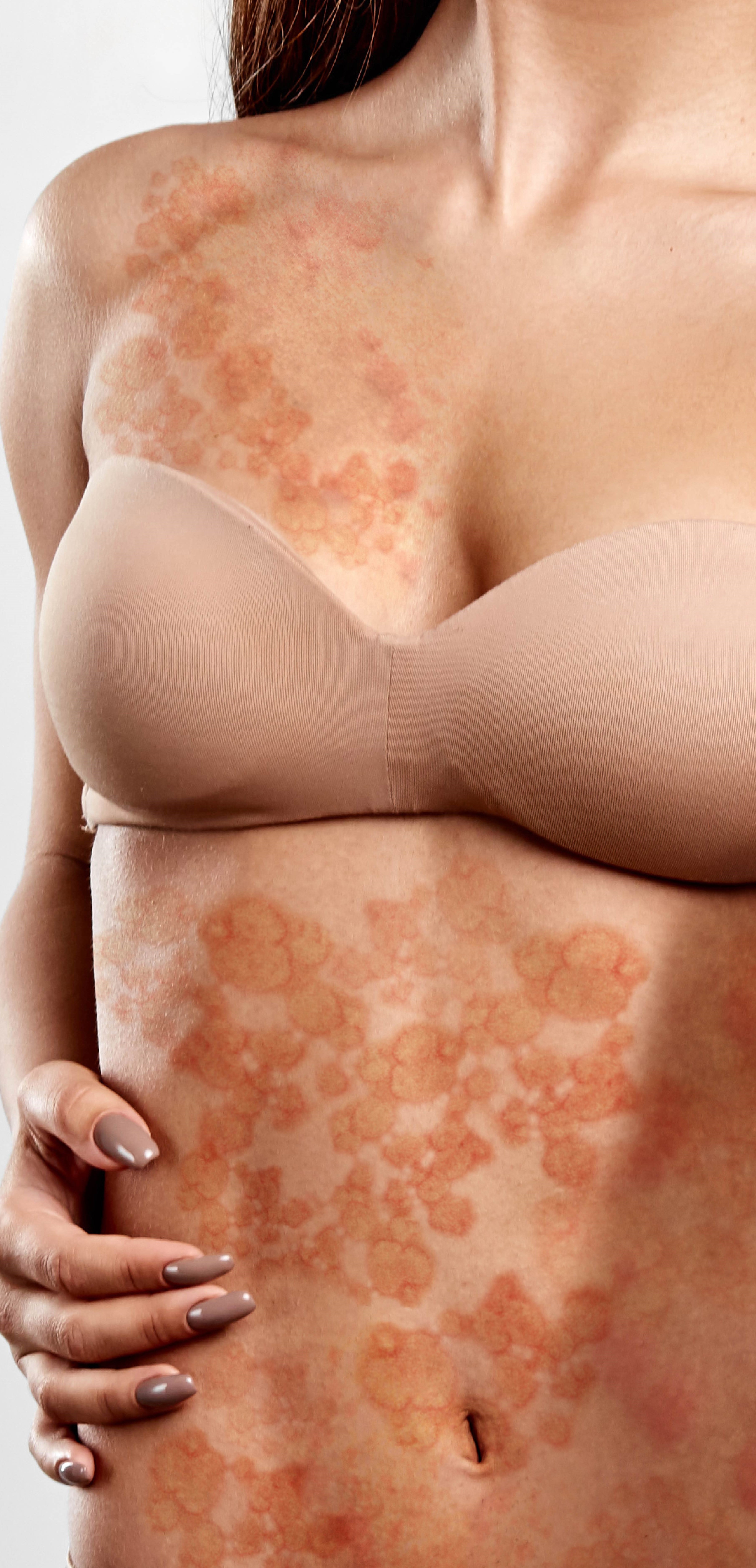 Urticaria. Mitos y Verdades