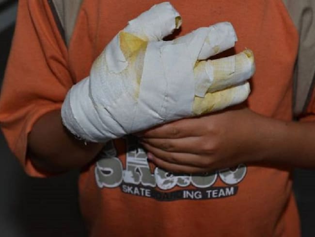 Por manipular una petaca un adolescente sufrió quemaduras de segundo grado en la mano y la cara.