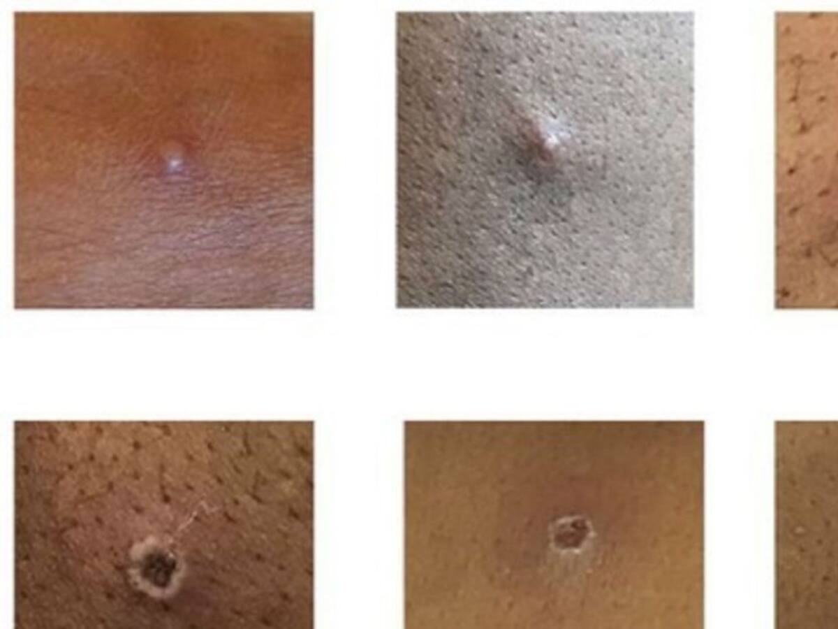 Cali se prepara ante la eventual llegada de la viruela del mono