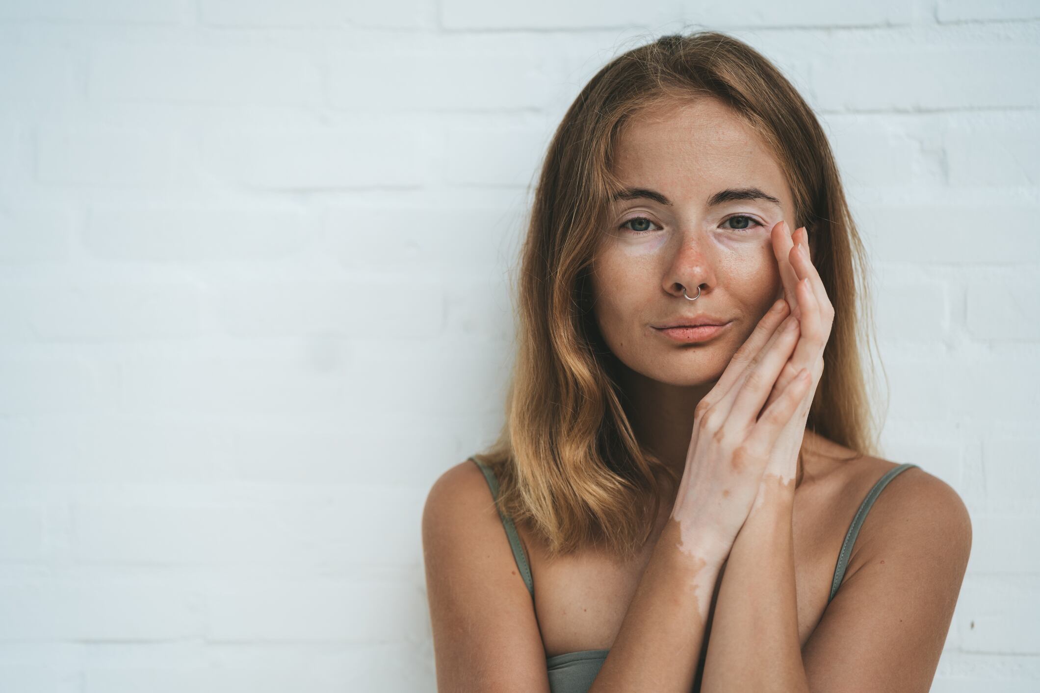 Vitíligo -  Getty Images