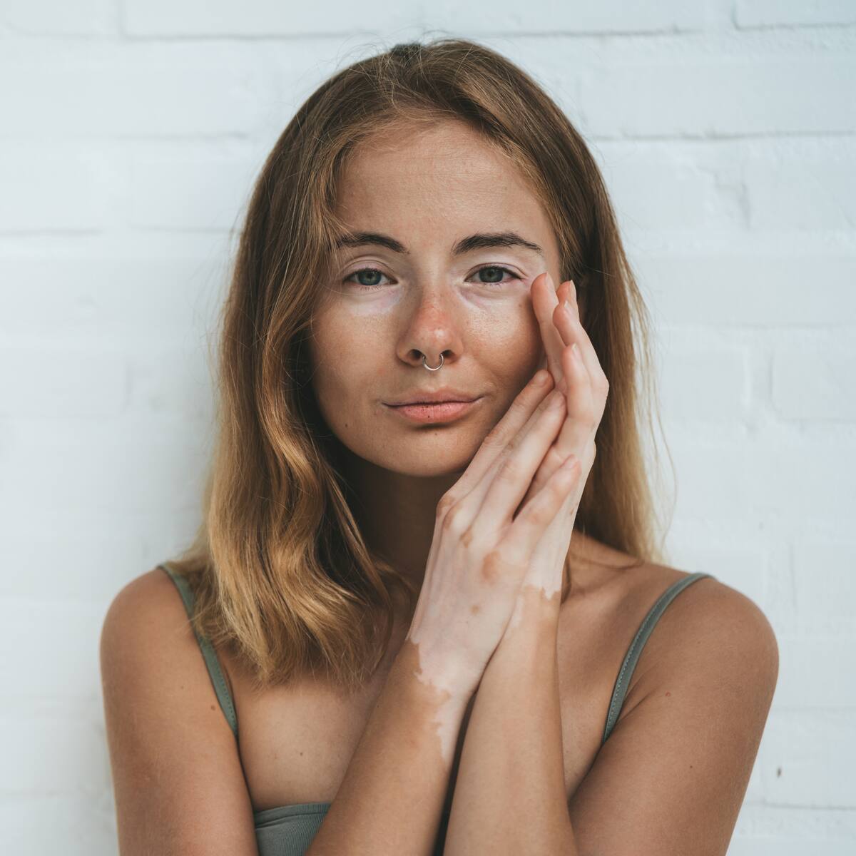 ¿Soy propenso a tener vitíligo?: Qué es y por qué la piel pierde su color