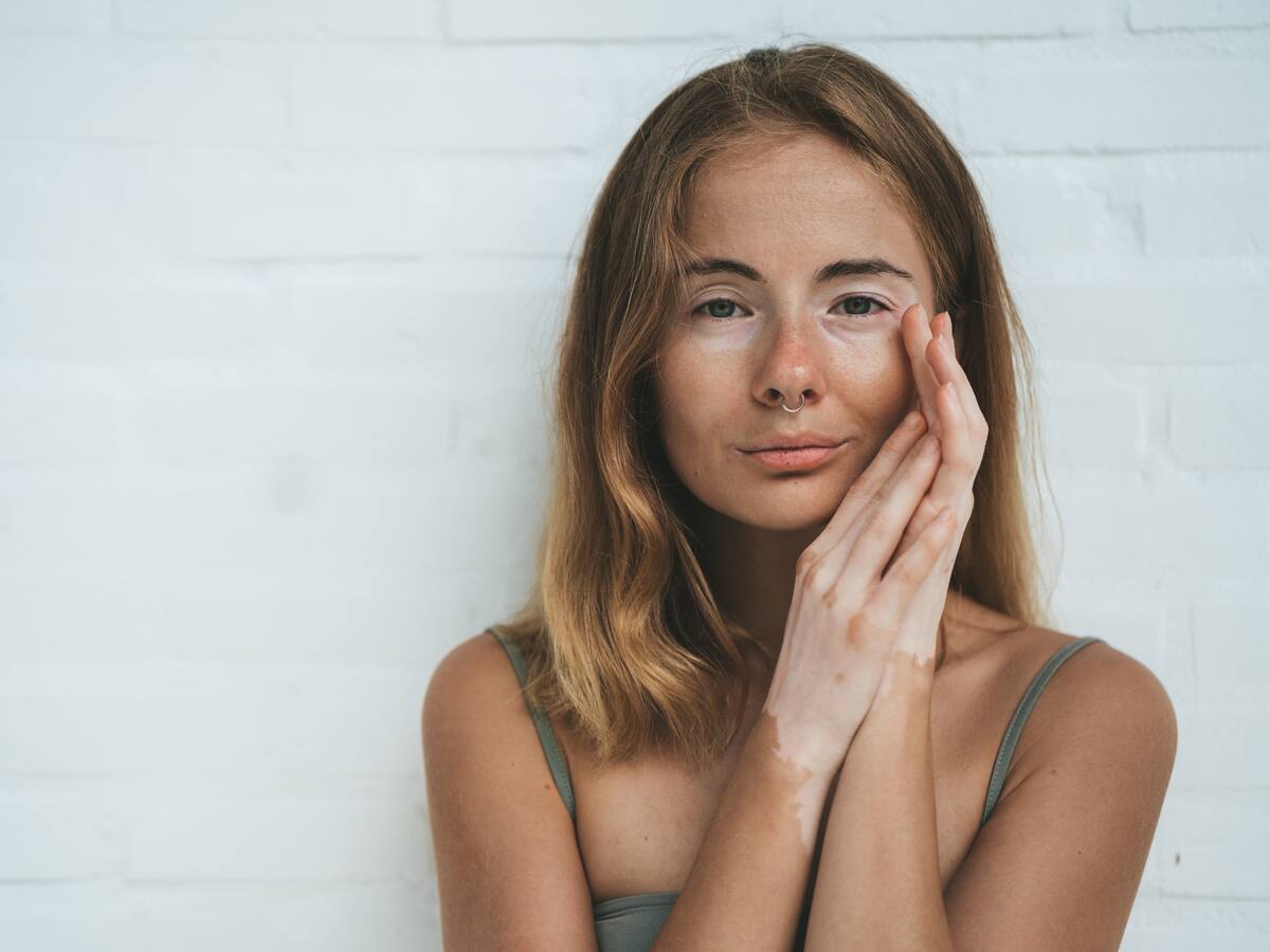 ¿Soy propenso a tener vitíligo?: Qué es y por qué la piel pierde su color