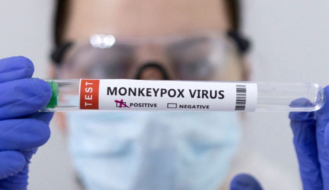 Pruebas de viruela símica.