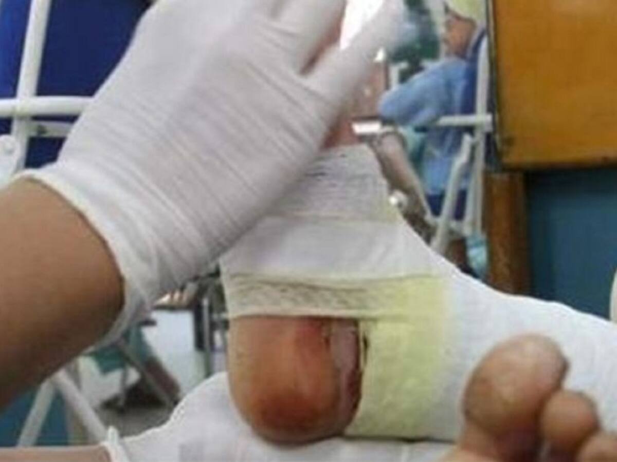 Planes de choque en el Valle para evitar más quemados por pólvora