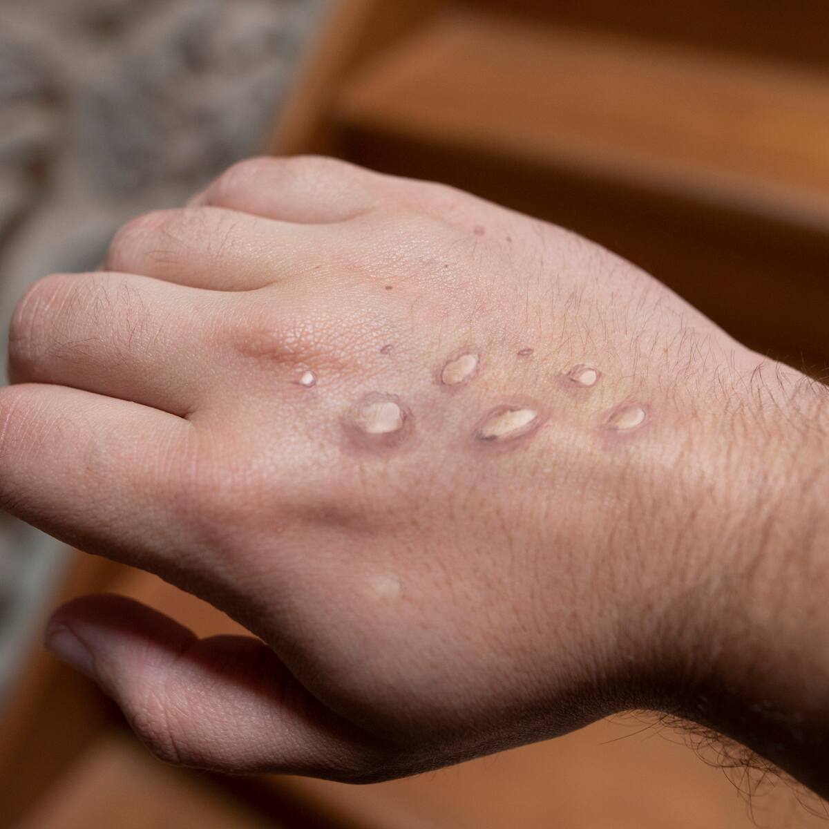 Mpox: OMS levanta emergencia sanitaria internacional por descenso de casos