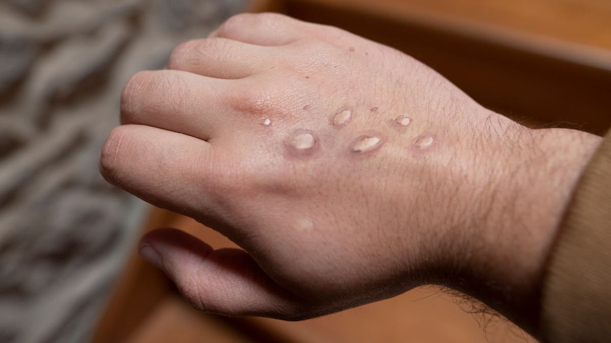 Bogotá confirma primer caso de viruela símica (mpox con variante Ib)